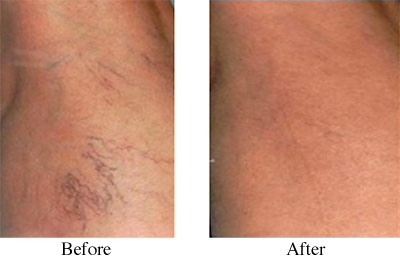 Sclerotherapy Results Los Angeles