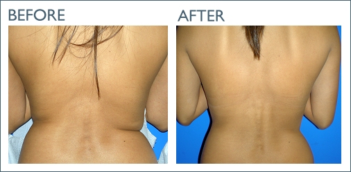 Lady with body fat on her back and lady after Mesotherapy and Kybella, Beverly Hills CA
