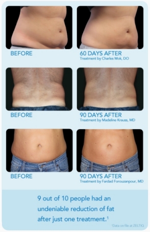 Get Rid of Bra Fat Flanks With Coolsculpting Beverly Hills, Los Angeles